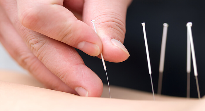 Acupuncture needles shown to be applied on a patient